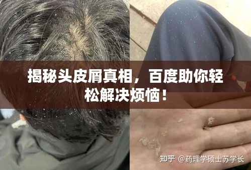 揭秘头皮屑真相,百度助你轻松解决烦恼!
